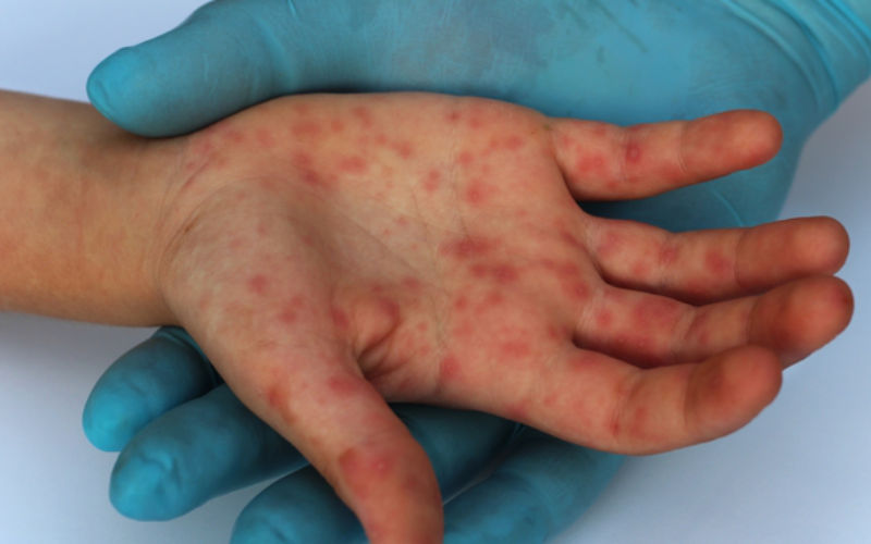 Measles Outbreak in Morocco Claims First Victim